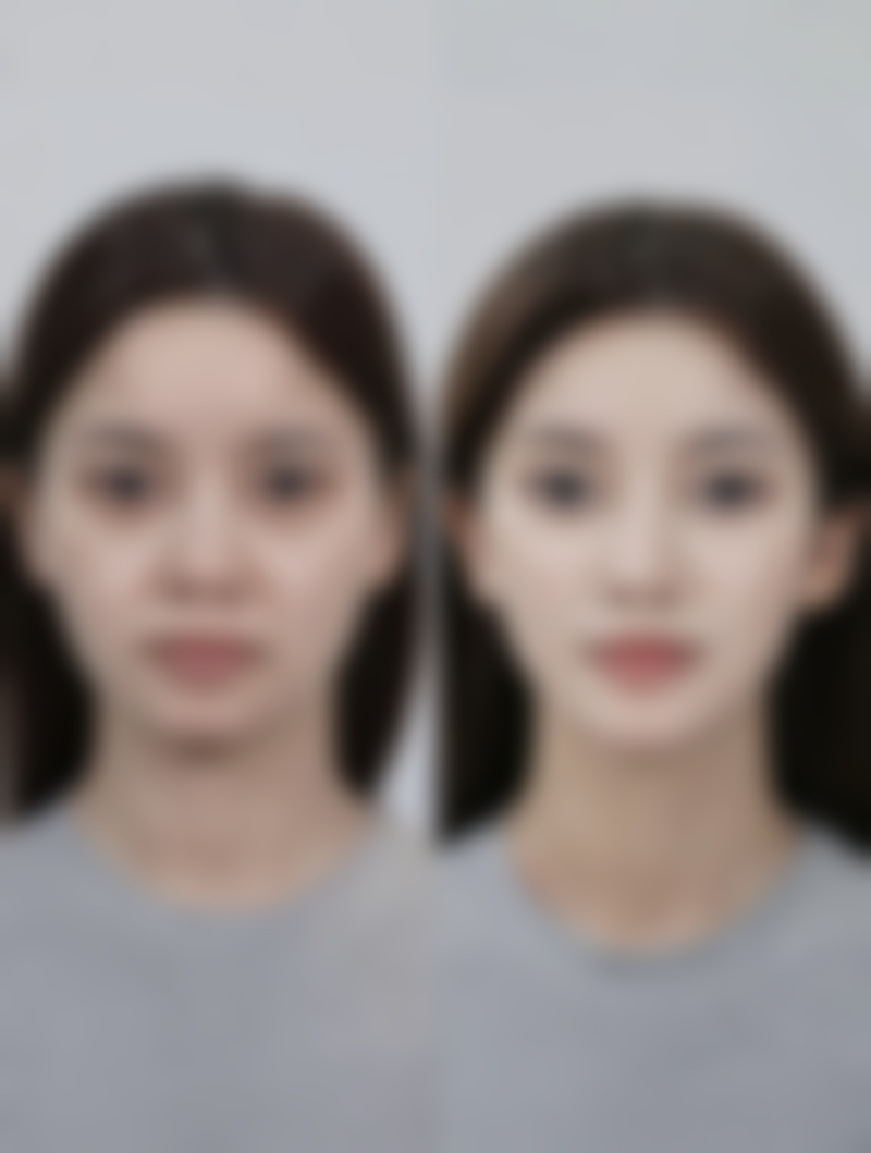 下颌跟下颚有什么区别？从定义、位置到医美处理及健康影响全解析