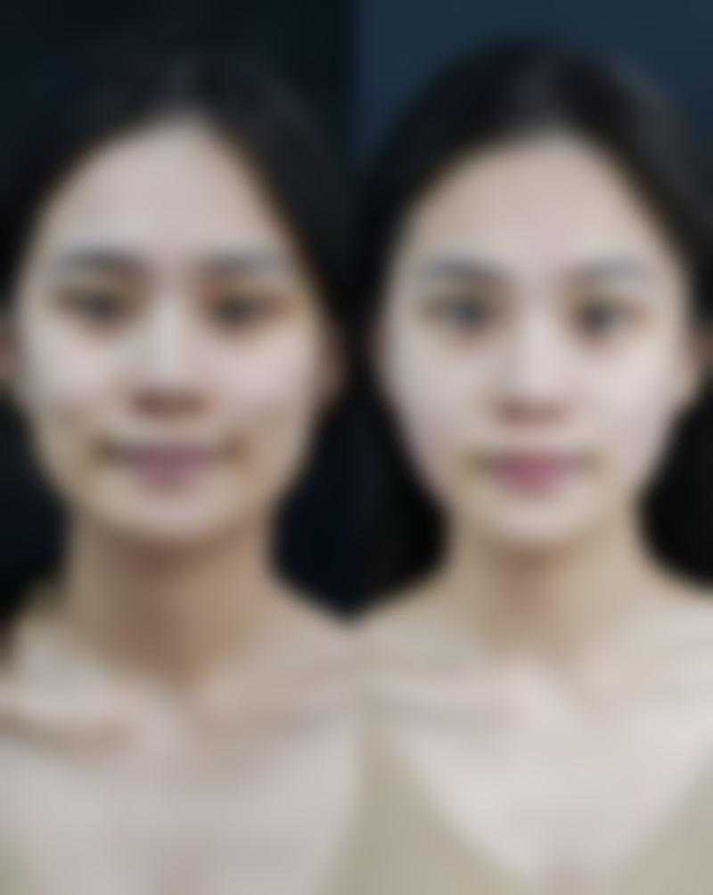 隆胸后有什么影响？生理心理生活皆有变化，乳房外观触感下垂风险几何