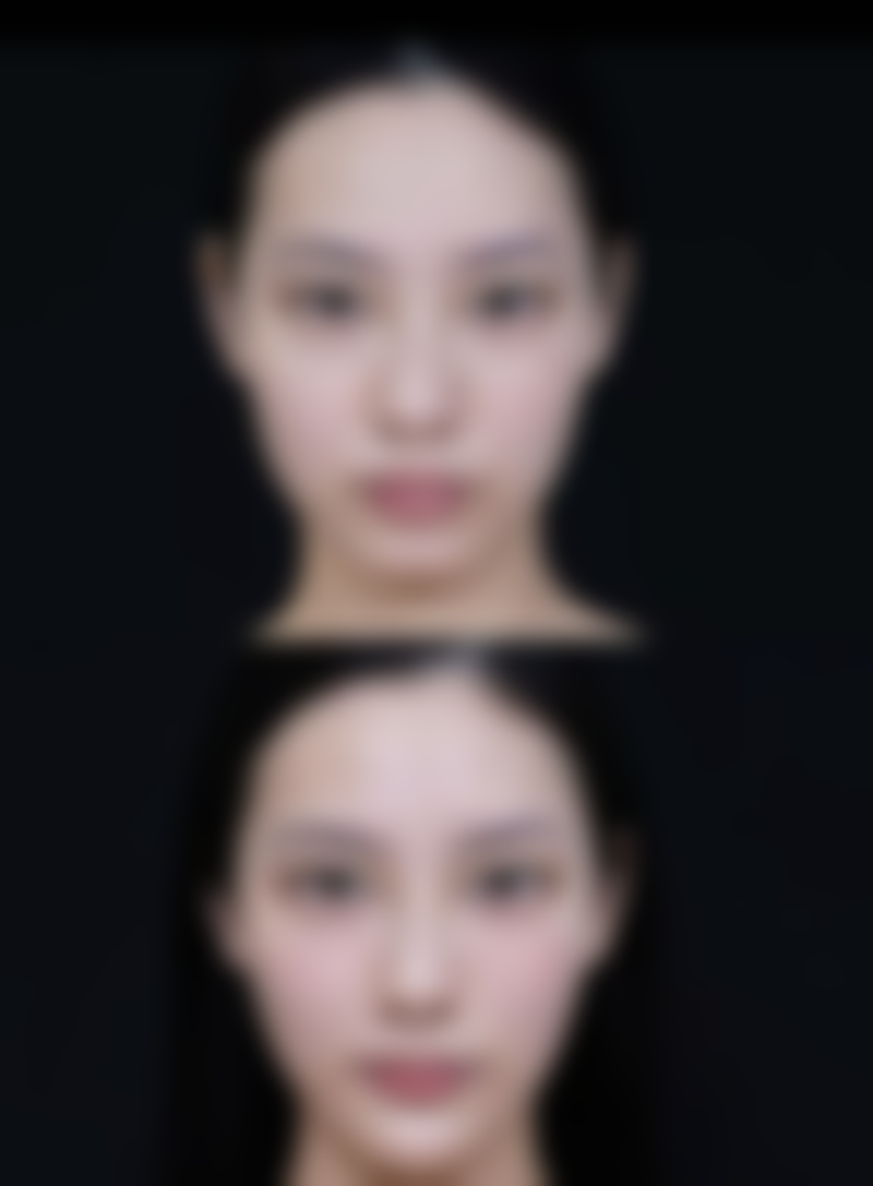 打理想白针后的护理要点