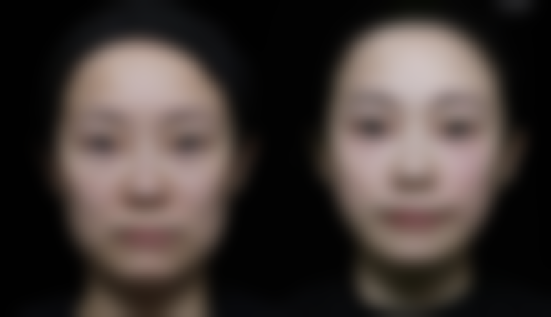 硅胶隆鼻可以恒久吗