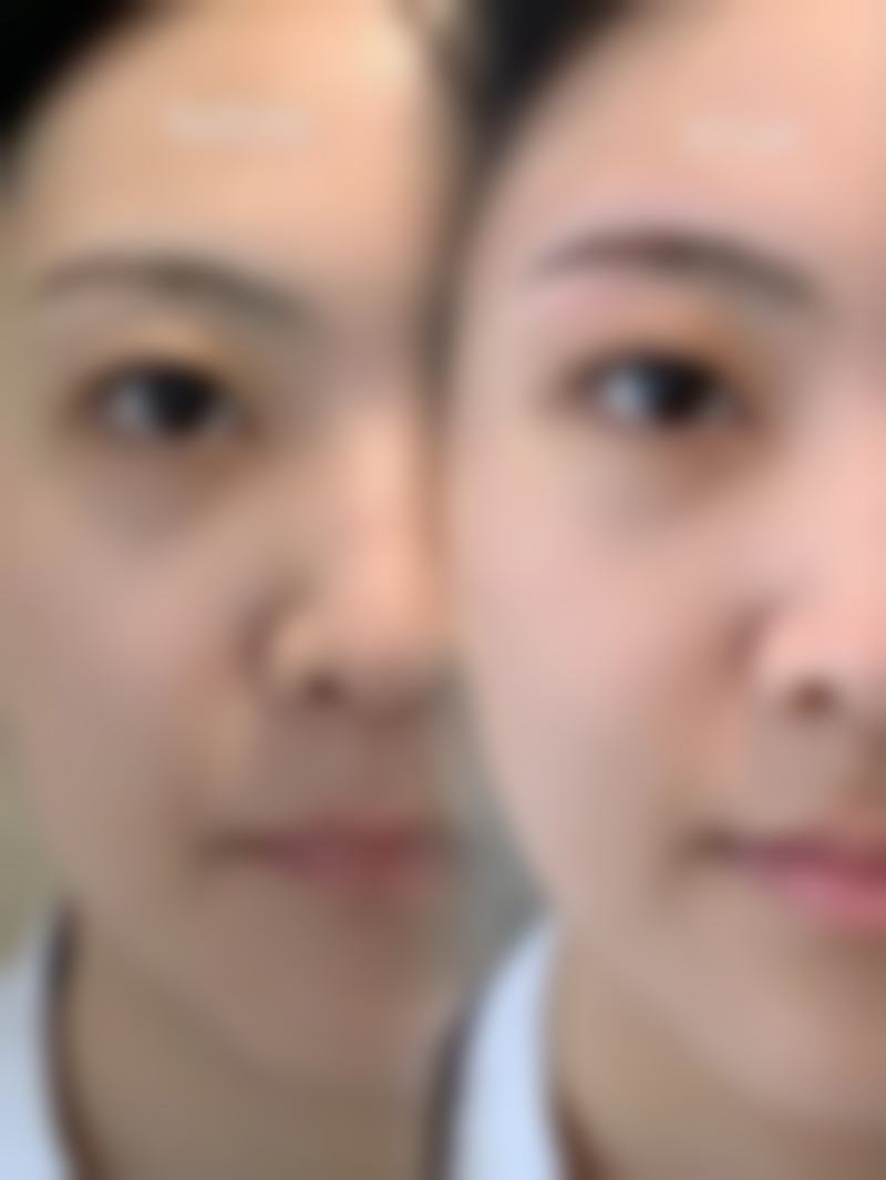 假体移位会造成怎样的影响