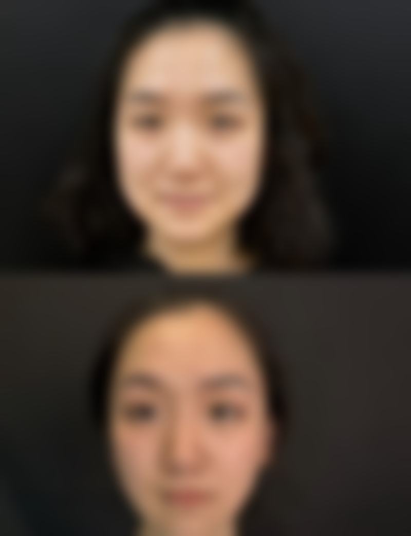 硅胶隆鼻老了鼻梁会变丑、变歪吗