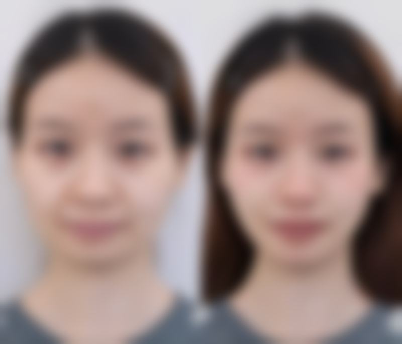 假体隆胸有副作用吗？可能有但选好假体做好护理，多数副作用可避免或改善 