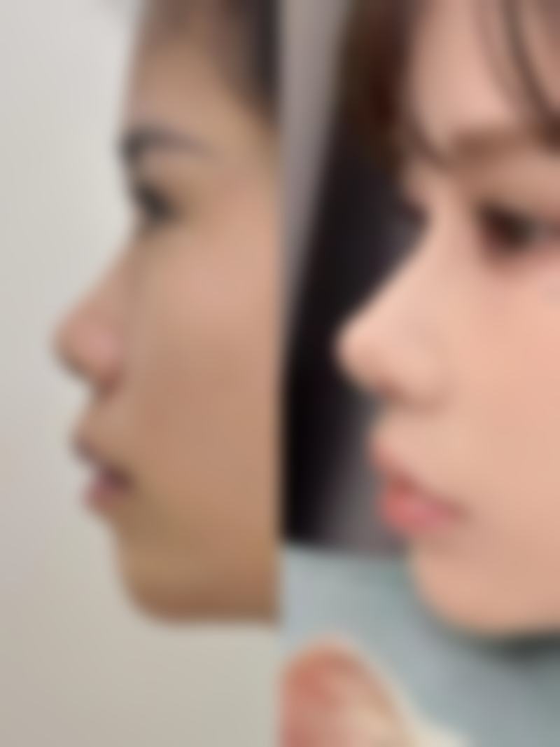 头发种植的毛囊分离和培养是怎样的