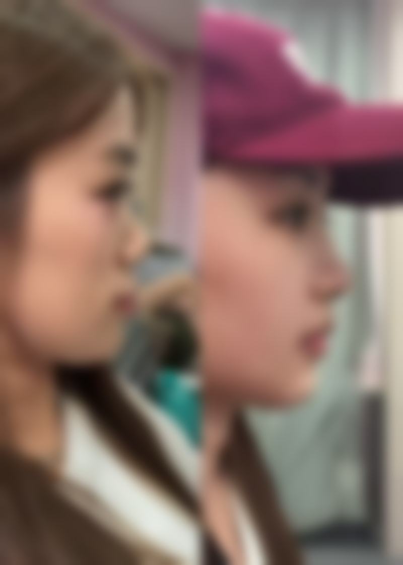 40岁女人去眼袋的医美手术方法