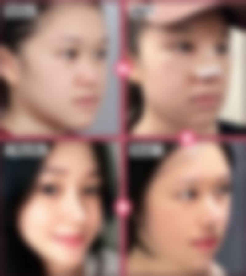 口呼吸凸嘴能矫正吗？纠正呼吸习惯、正畸治疗等综合措施助你改善嘴凸