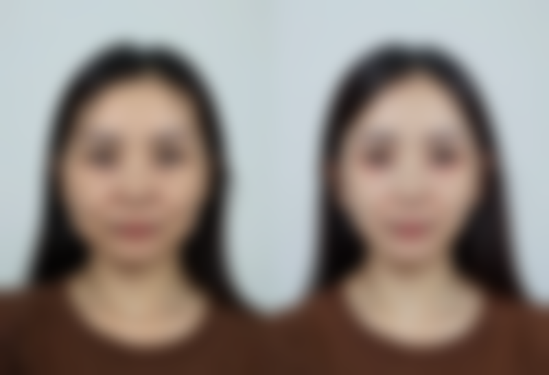 头发种植时如何进行麻醉