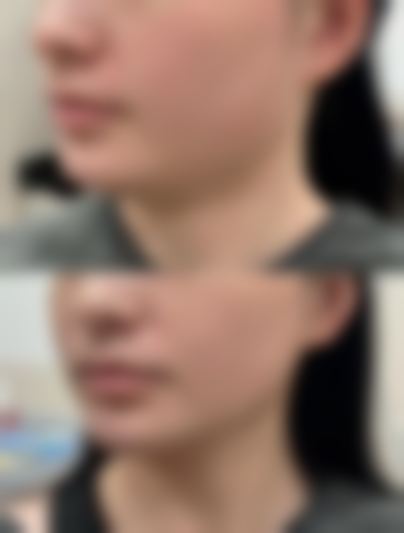 打瘦脸针有没有什么危害？操作、个体及频率有风险，选对医院和注意事项很重要