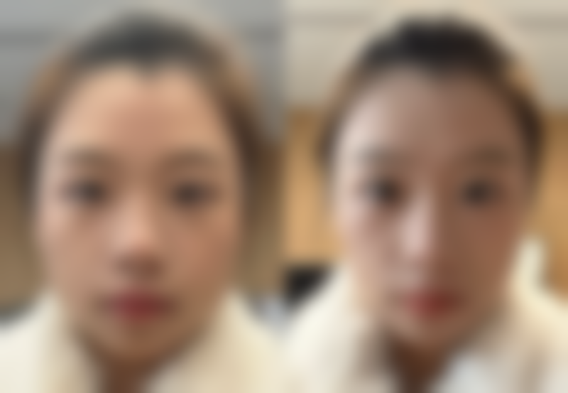 超声波祛眼袋的成效如何