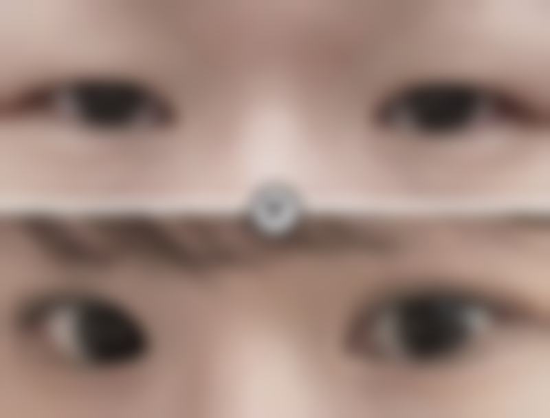 超声波祛眼袋的缺点是什么