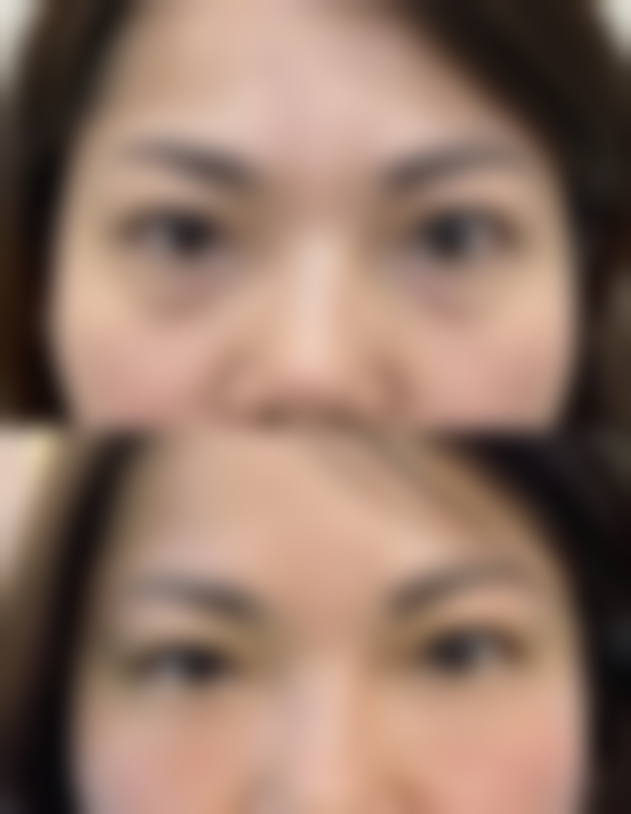 瘦脸针注射作用存在哪些限制