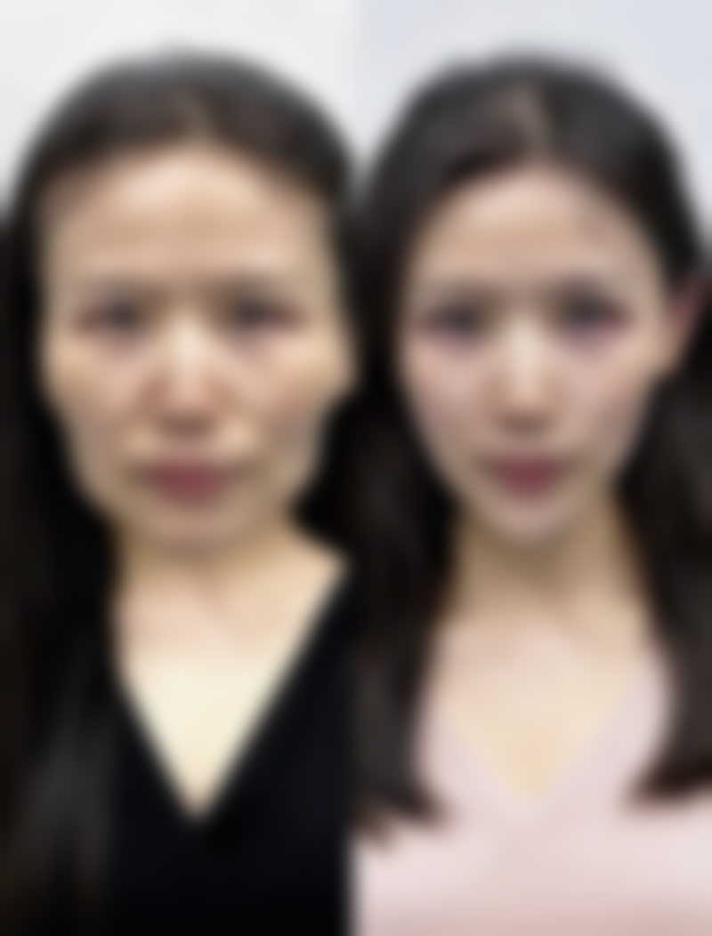 男士平时怎样去眼袋？从生活习惯、护理妙招到手术治疗为你一一解答