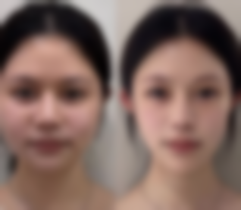 达州爱尔博视医院胡建斌医生技术好不好？