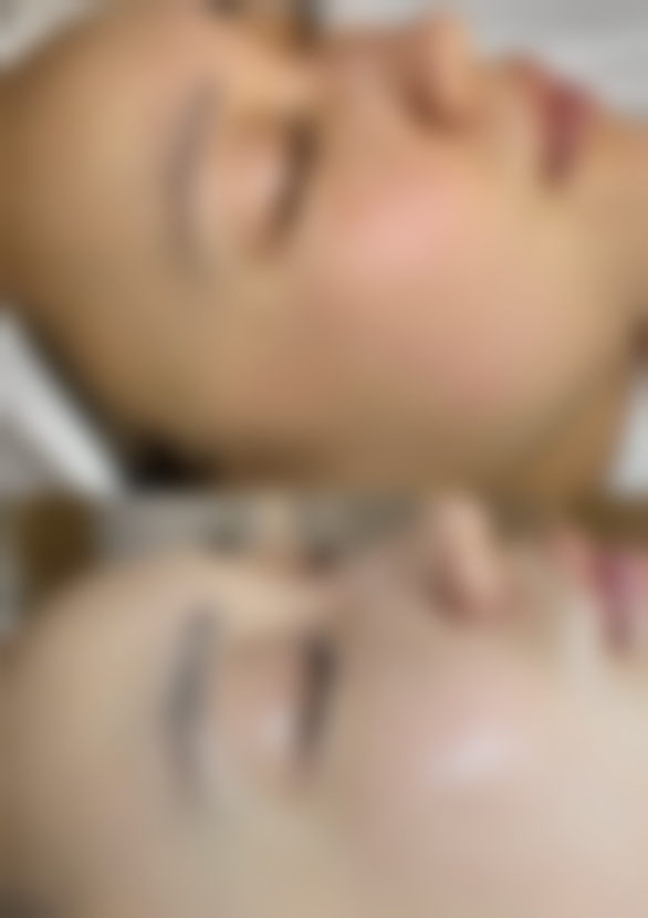 嘴唇外突怎么整形？牙齿矫正、唇部整形、正颌手术及非手术法助你改善