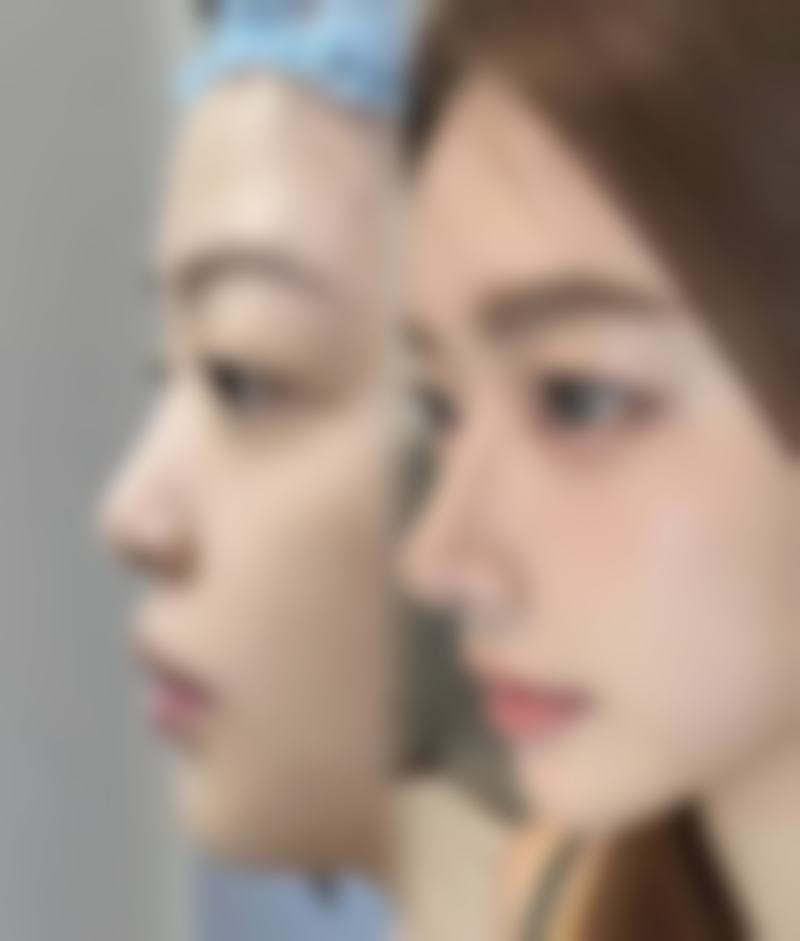 哪些因素会影响抽脂手术的安心性