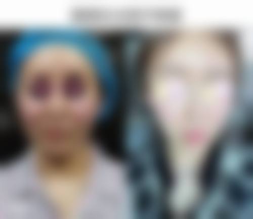 头发种植后的成效和护理