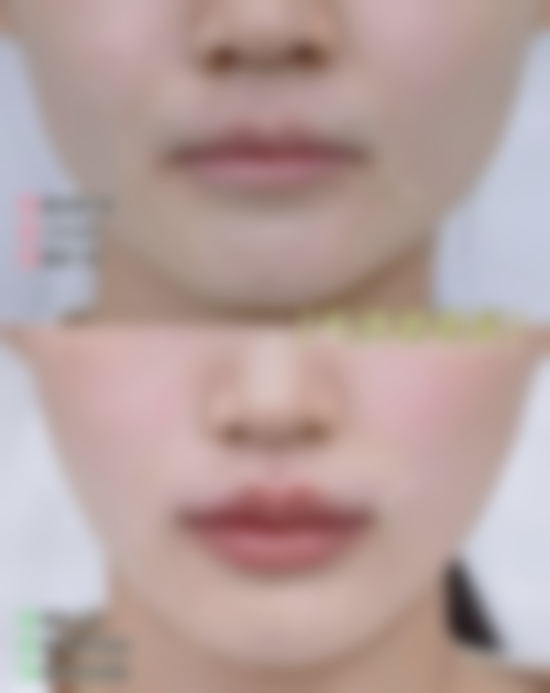 抽脂手术对身体危害大吗之长期健康影响