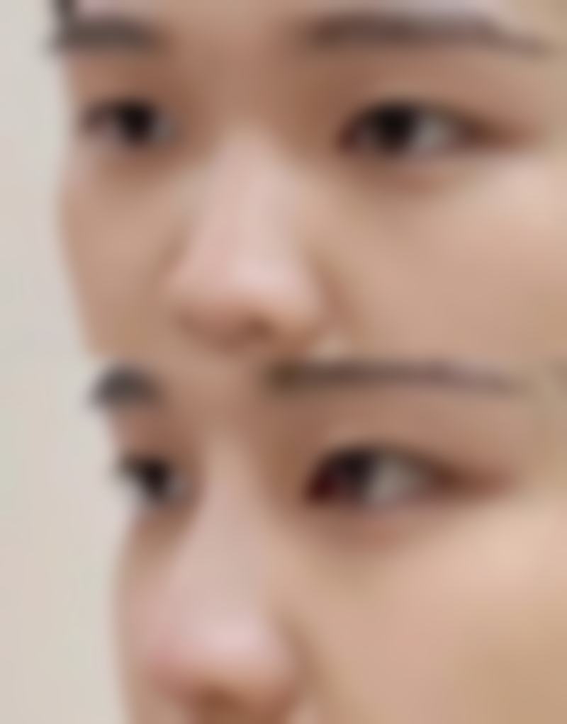 关于小阴唇缩小手术的其他注意事项