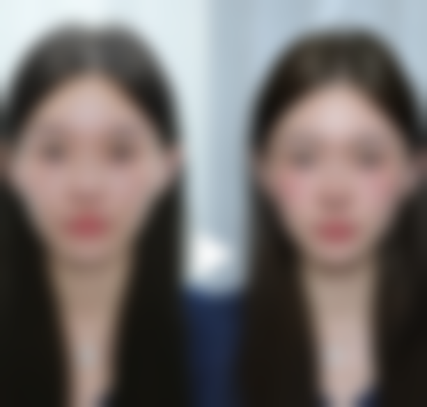 郑州曙光植发微针植发的优势是什么?