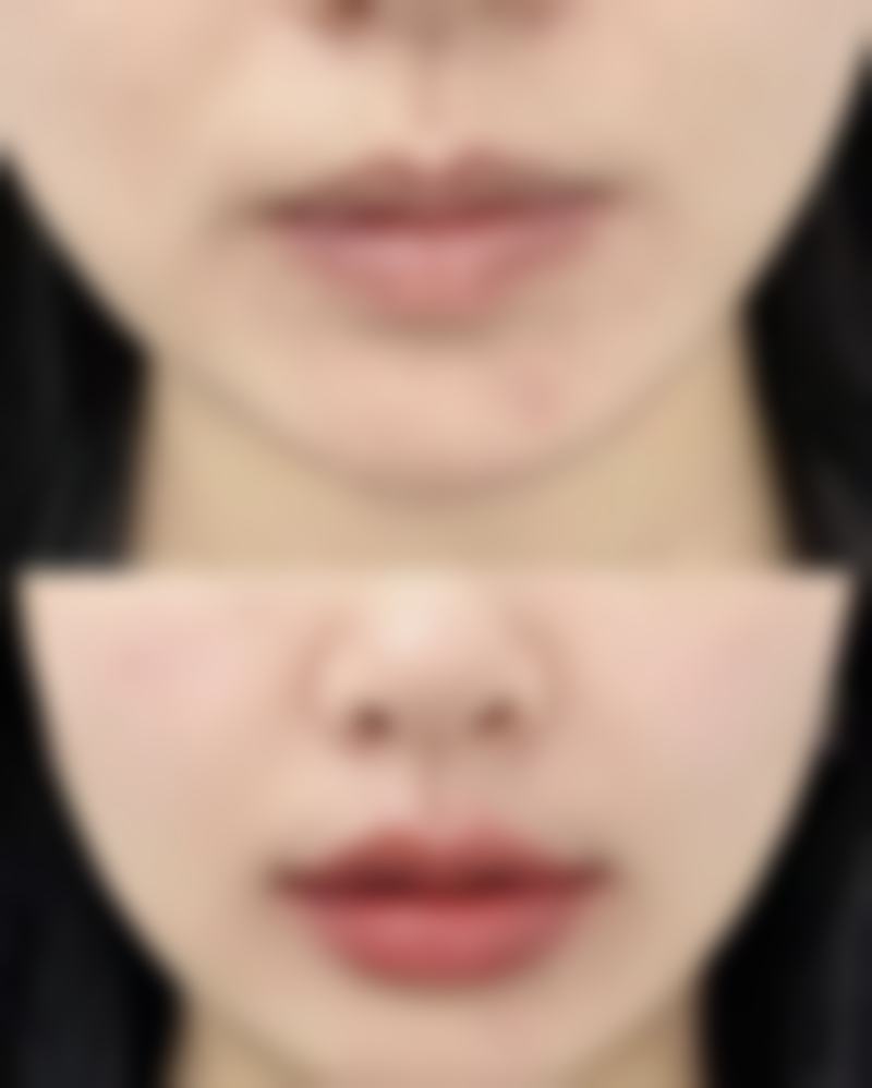 总结——北京韩韵坊整形医院胡钟智医生怎么样？