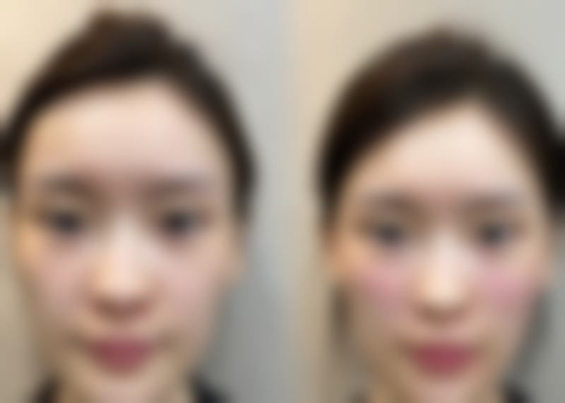 总结——北京艾丽斯妇科医院赵美容医生怎么样?