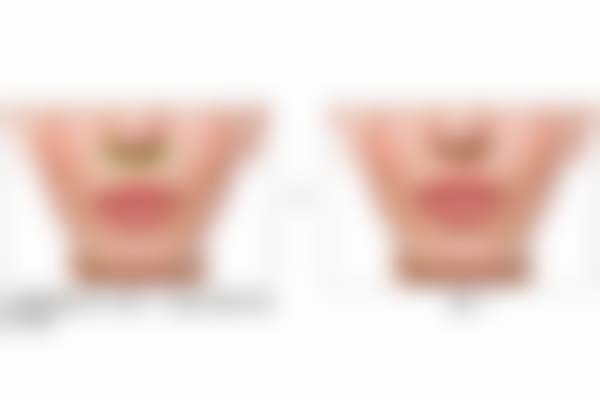 北京蕾士悦容医疗美容门诊部秦小鹏手术风格：适配个人鼻型自然天成，门诊部实力强价格合理速来！ 