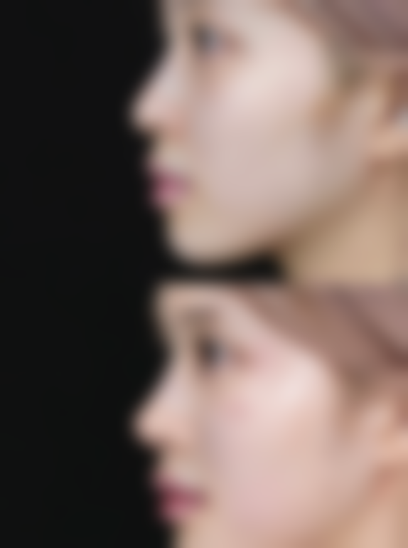 修复额头凹疤痕的常见方法