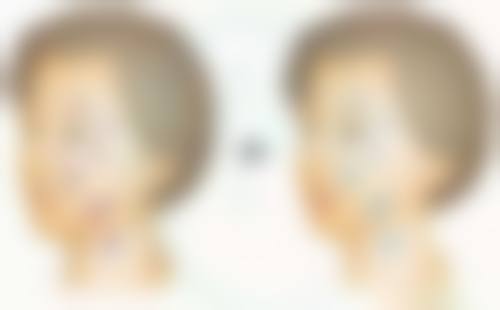 双眼皮大综合和小综合的手术成效区别