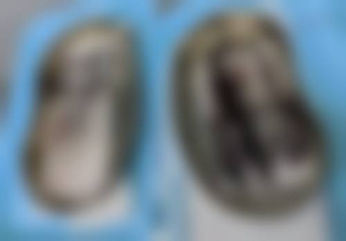 双眼皮大综合和小综合的手术时间与修复时间区别