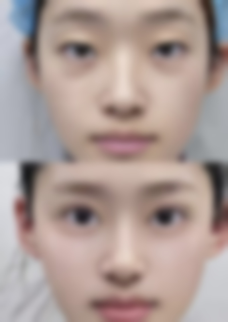 双眼皮Kiss技术和Park技术各有什么特点？