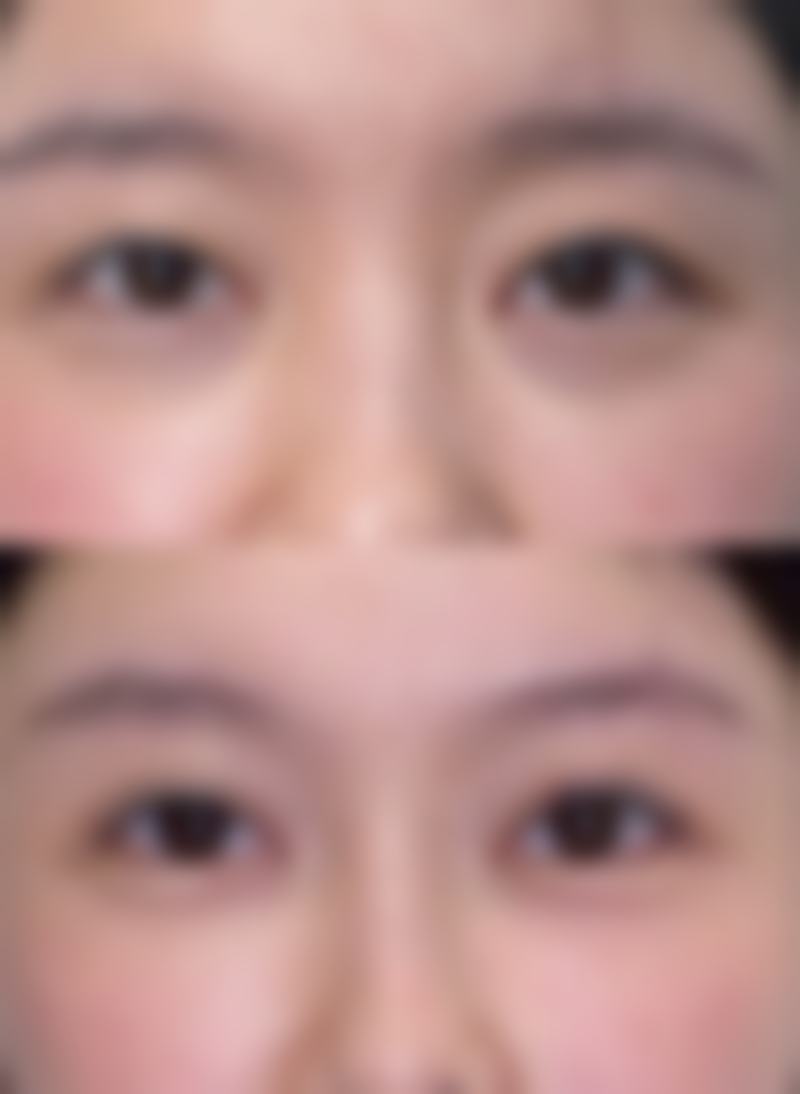 外用药物治疗红色疤痕