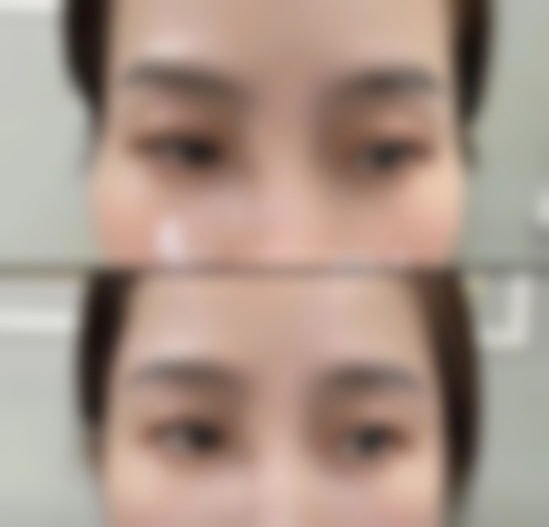 手术出现意外状况时假体隆胸要住院多久