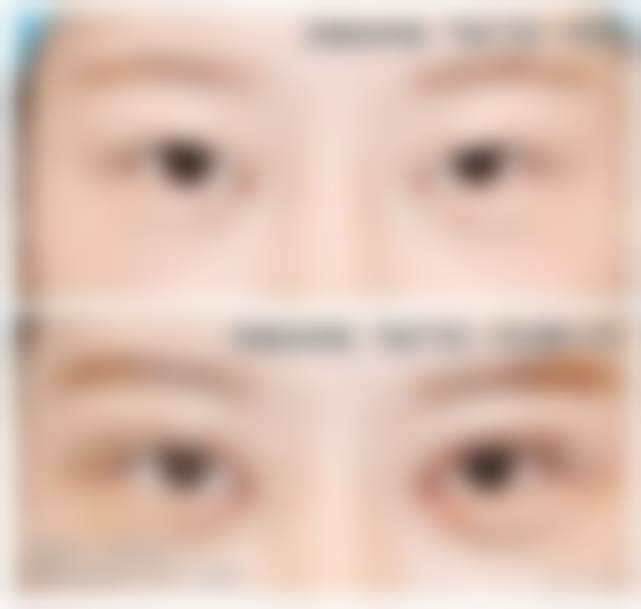 北京张冰洁医生的眼修复价格