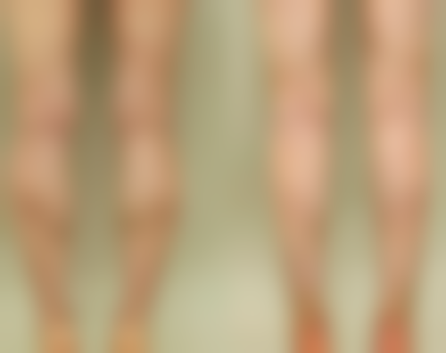 43岁适合的双眼皮手术方式