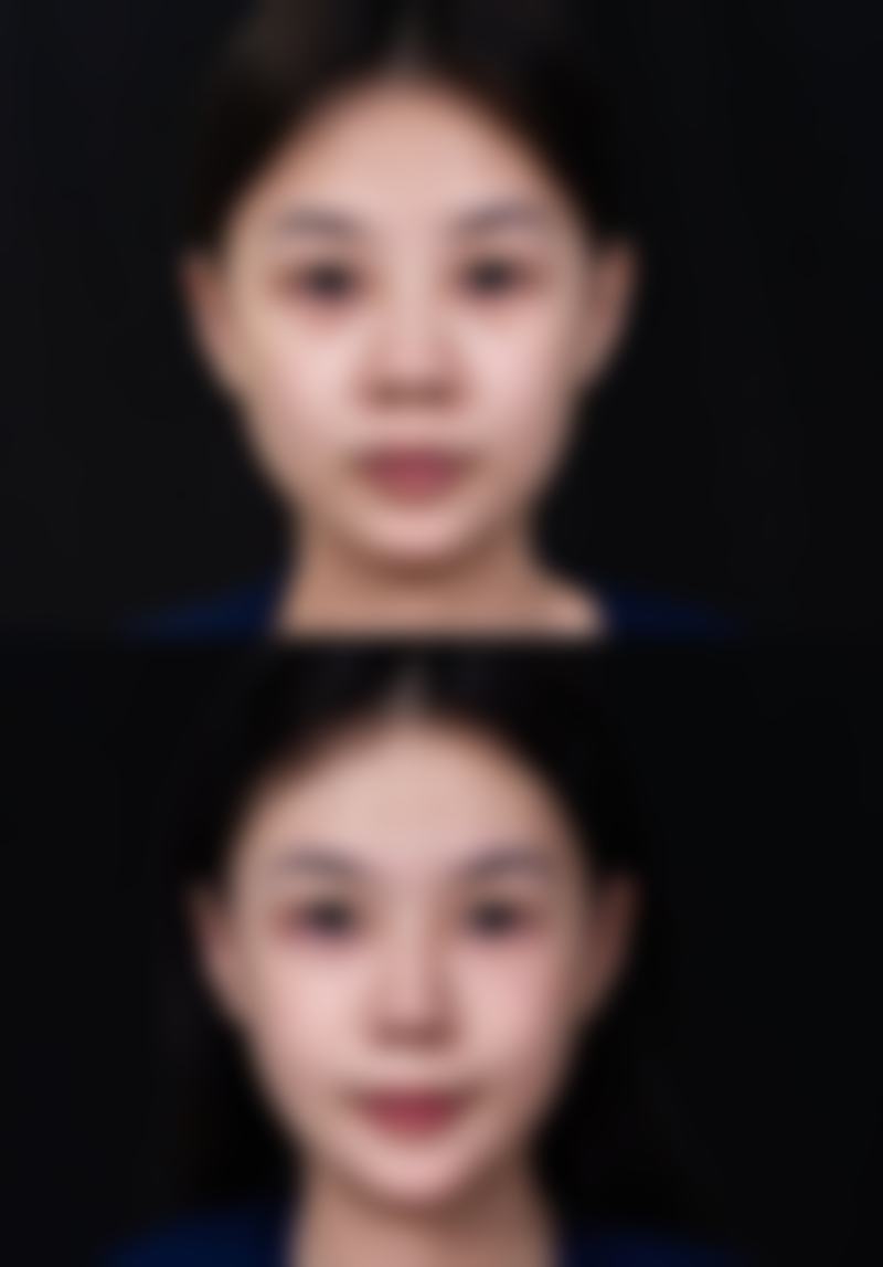 微针刺激疗法对增生疤痕的作用