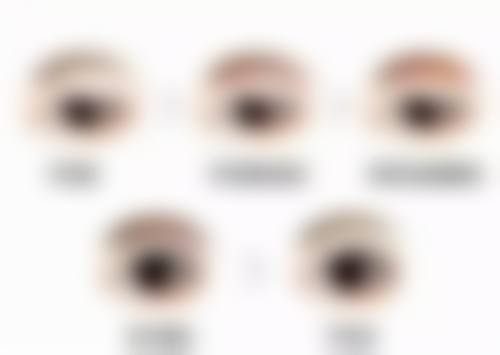 常见割双眼皮方法的原理