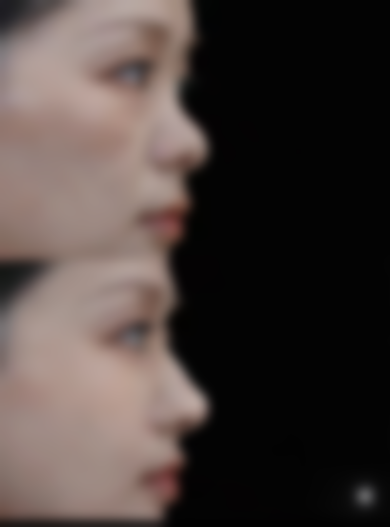 面部吸脂会不会有危险的总结