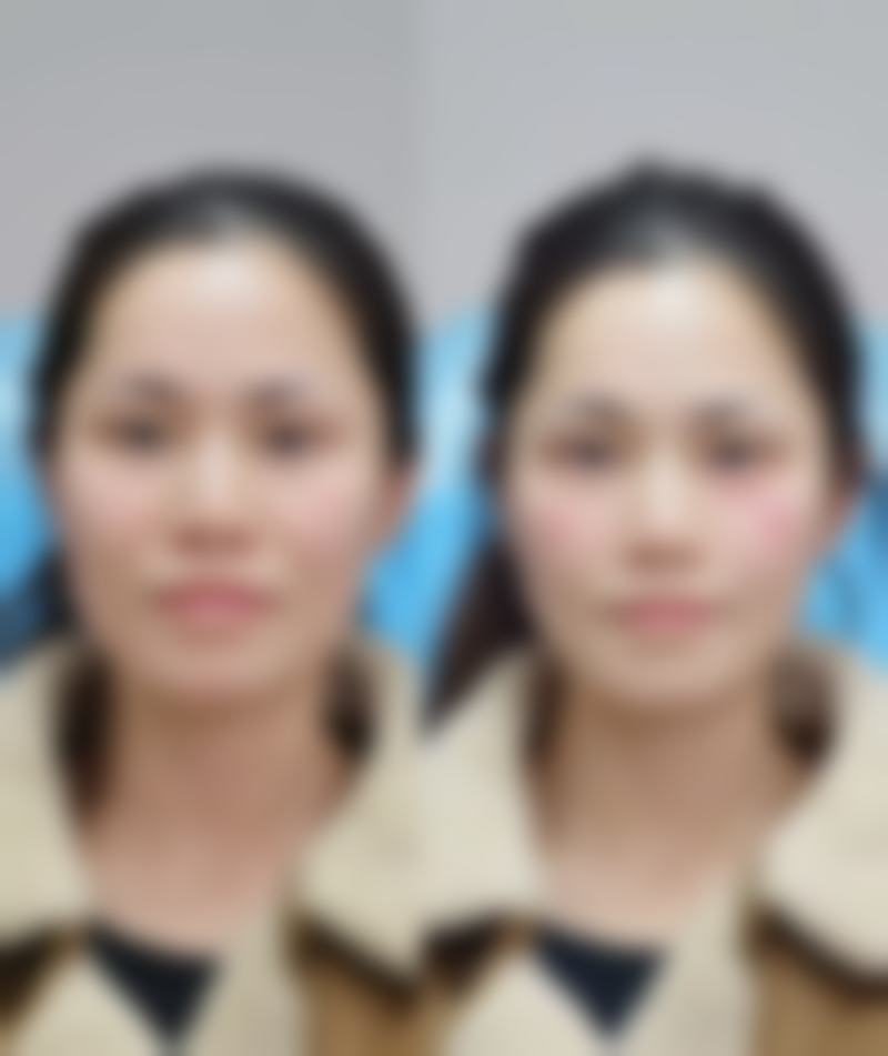 如何降低面部吸脂的危险