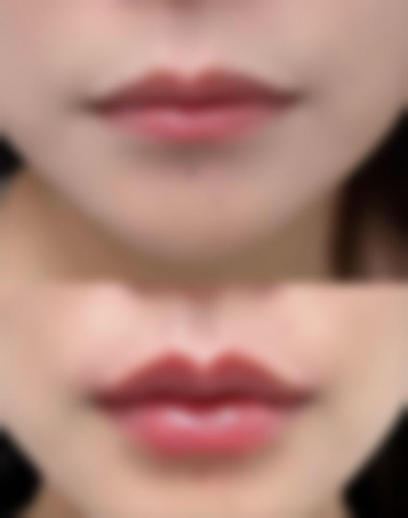 隆胸手术的风险和注意事项