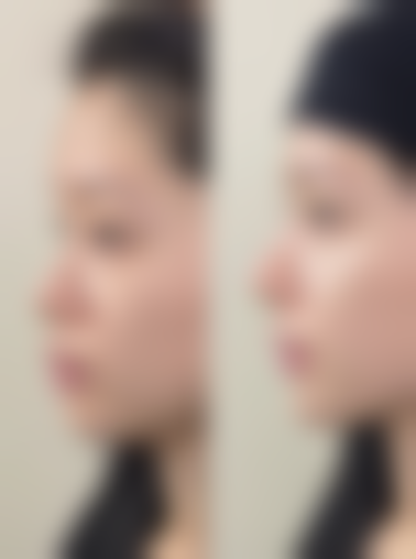 不同手术方式的修复时间和上班建议