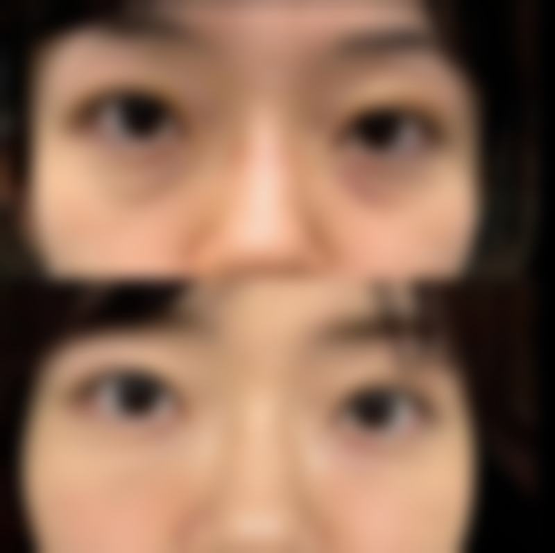 埋线双眼皮多久可以定型？一般1 - 3个月基本定型但受体质护理等因素影响 