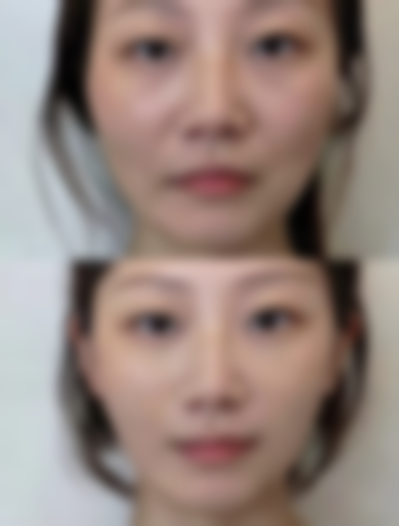 割双眼皮多久可上班？不同术式恢复时间不同，一般埋线2 - 3天、三点5 - 7天、全切10 - 15天 