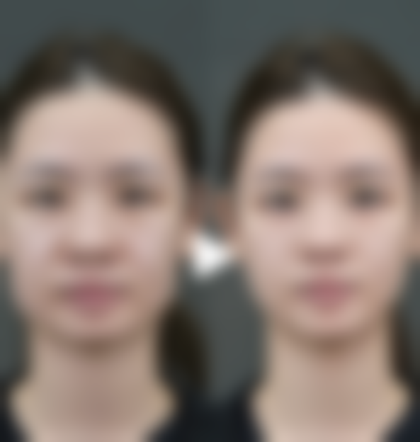 手臂吸脂手术的过程和成效