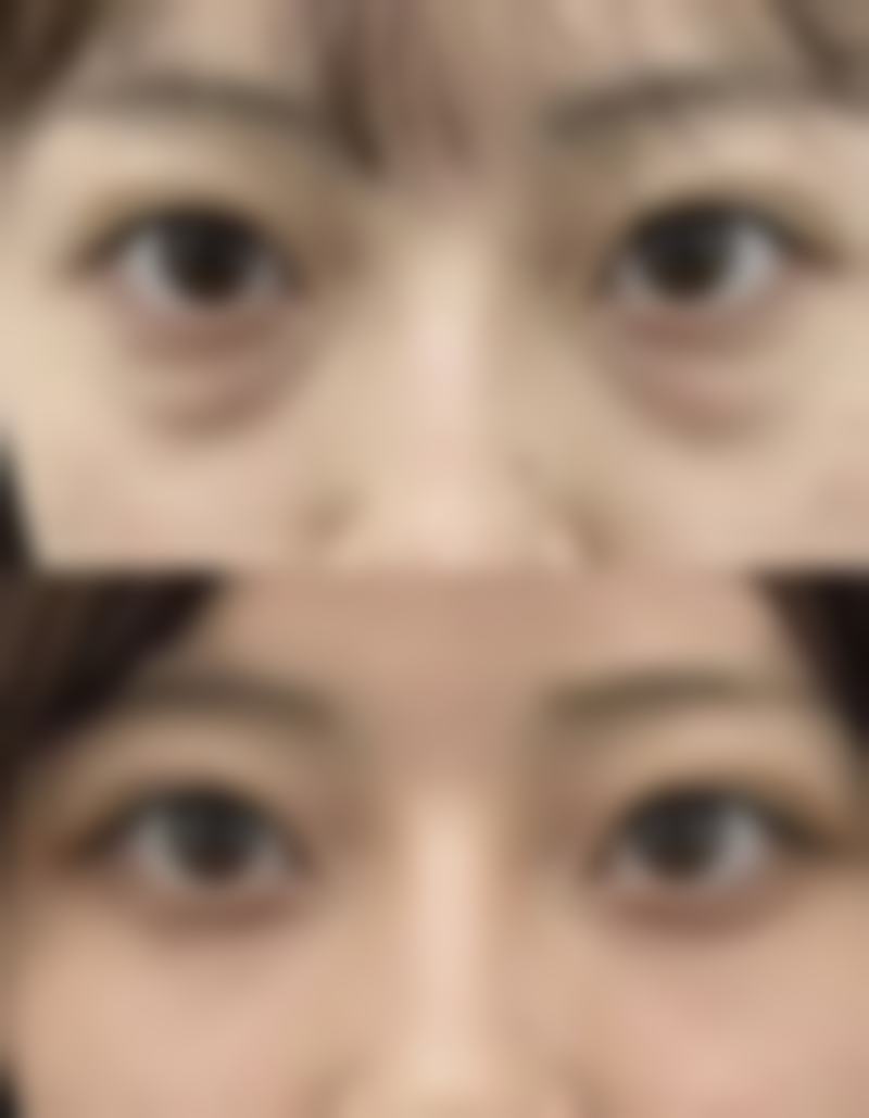 欧束菲眼霜真的能去眼袋吗 轻度水肿型有效 先天及严重结构性眼袋难根治