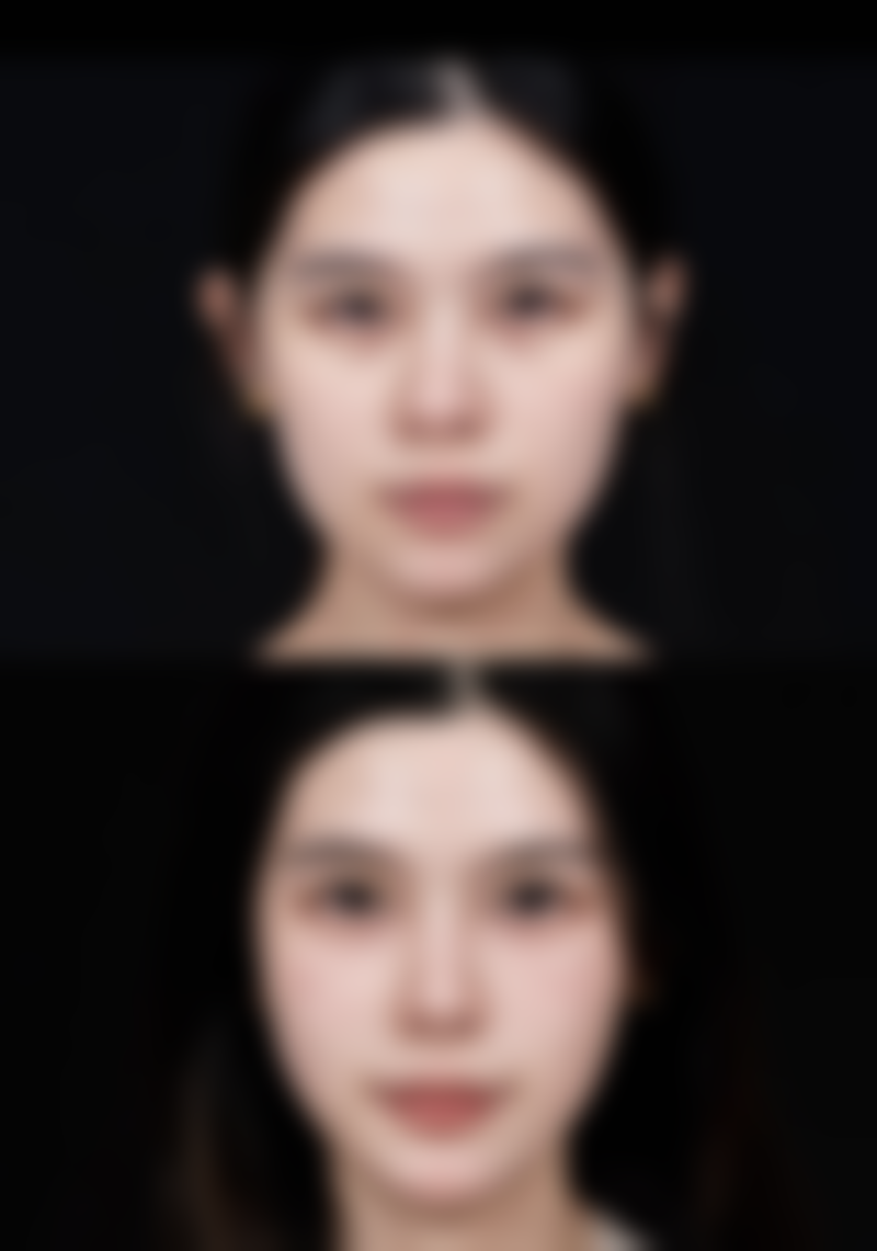 吸脂瘦手臂效果好不好？了解优缺点、影响因素及价格，助你拥有纤细手臂