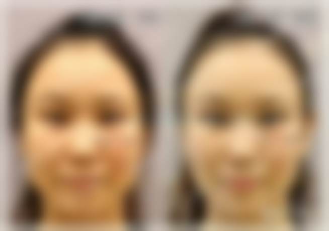 北京客来美舍医疗美容诊所江会芳擅面部精细整形，双眼皮隆鼻等项目打造的惊艳效果绝了！ 