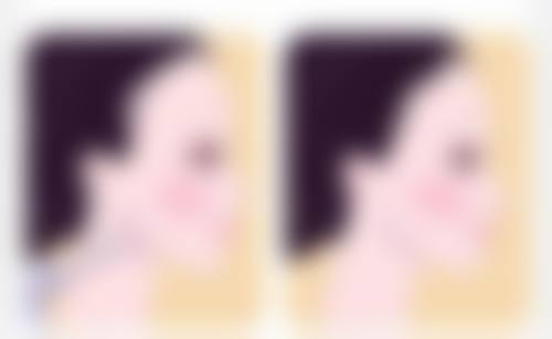 抽脂让屁股变小有什么风险和后遗症