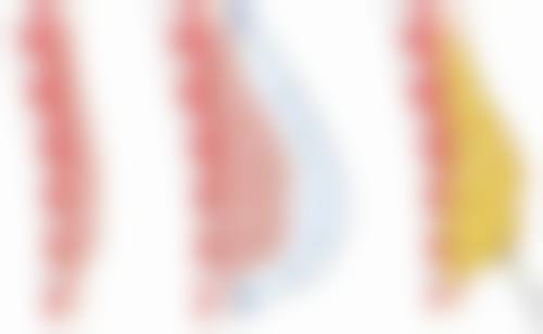 做了双眼皮怎么快速消肿？冷敷热敷、饮食调理、正确姿势多管齐下