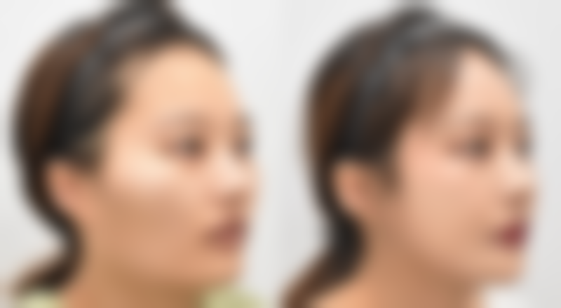 去眼袋的价格受哪些因素影响