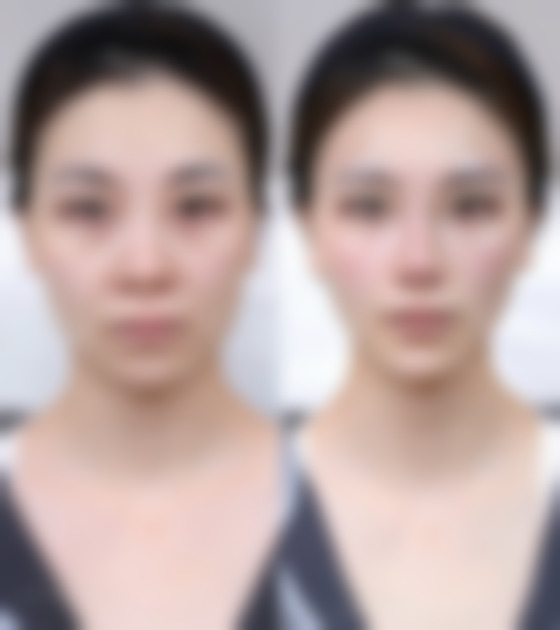 简单的日常去眼袋方法